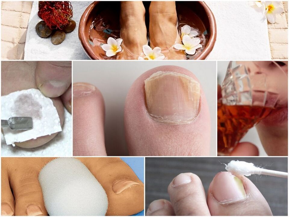 Tratamento de fungos de uñas